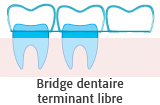 Bridge dentaire terminant libre