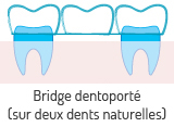 Bridge dentaire dentoport