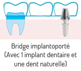 Bridge dentaire implantoport