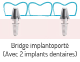 Bridge dentaire implantoport
