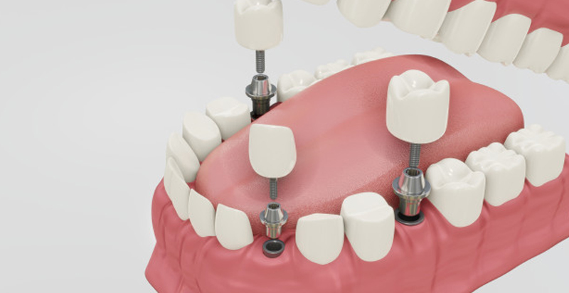 Implant pilier et couronne dentaire
