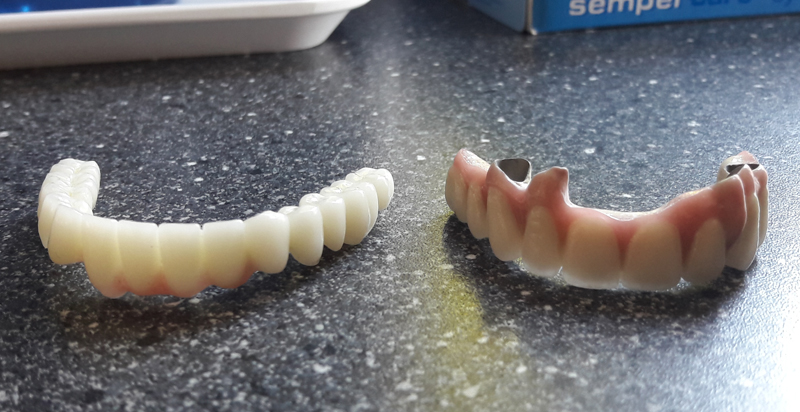 Difference couronne dentaire ceramo-metal et zircone