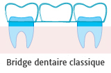 Bridge dentaire