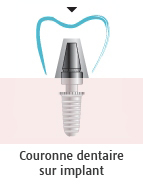 Implant dentaire a prise directe