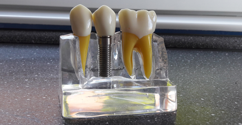 Implant dentaire en Hongrie