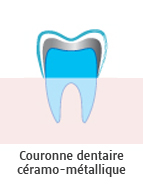 Couronne dentaire ceramo-metal