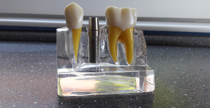 Implant dentaire en Hongrie